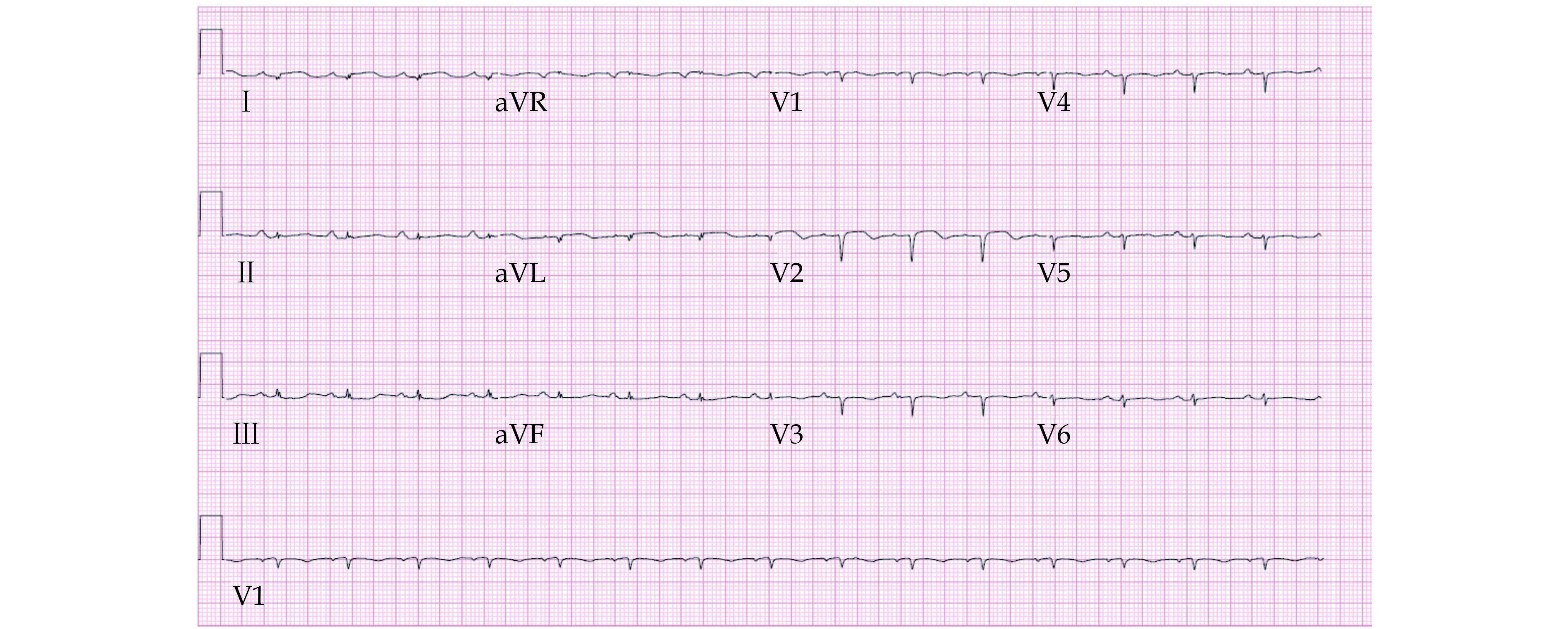 Sinus Tachycardia Ecg