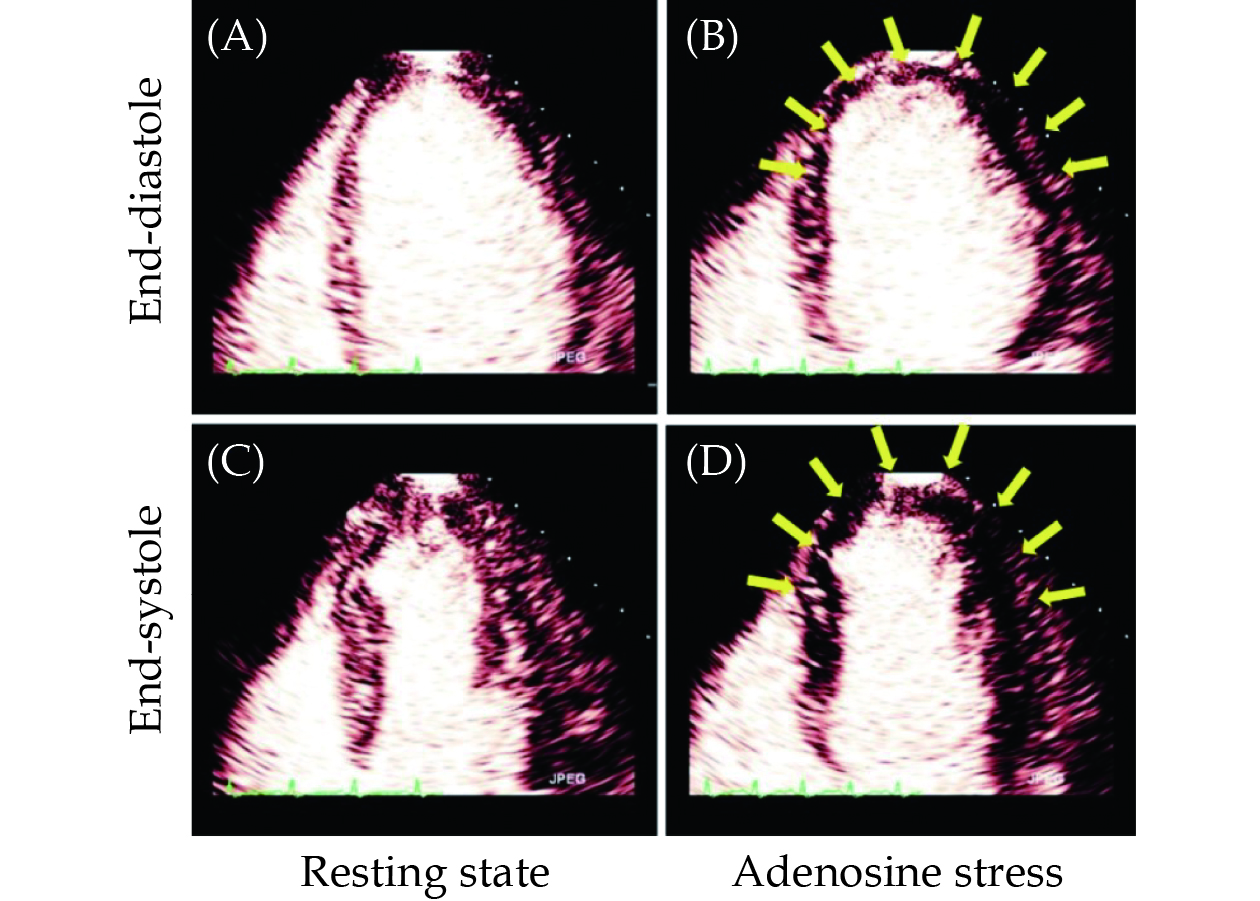 Stress Echocardiography for Chronic Coronary Syndrome: Clinical Practice  Guidelines (2023)